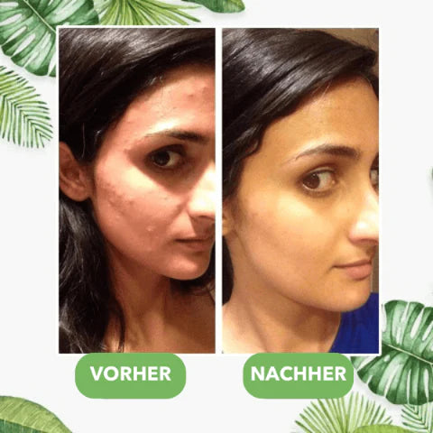 GreenStick™ - Mask för djuprengöring av porerna
